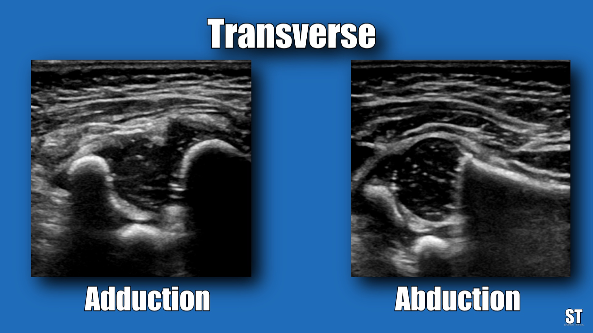 Transverse Hip Ultrasound Hot Sex Picture