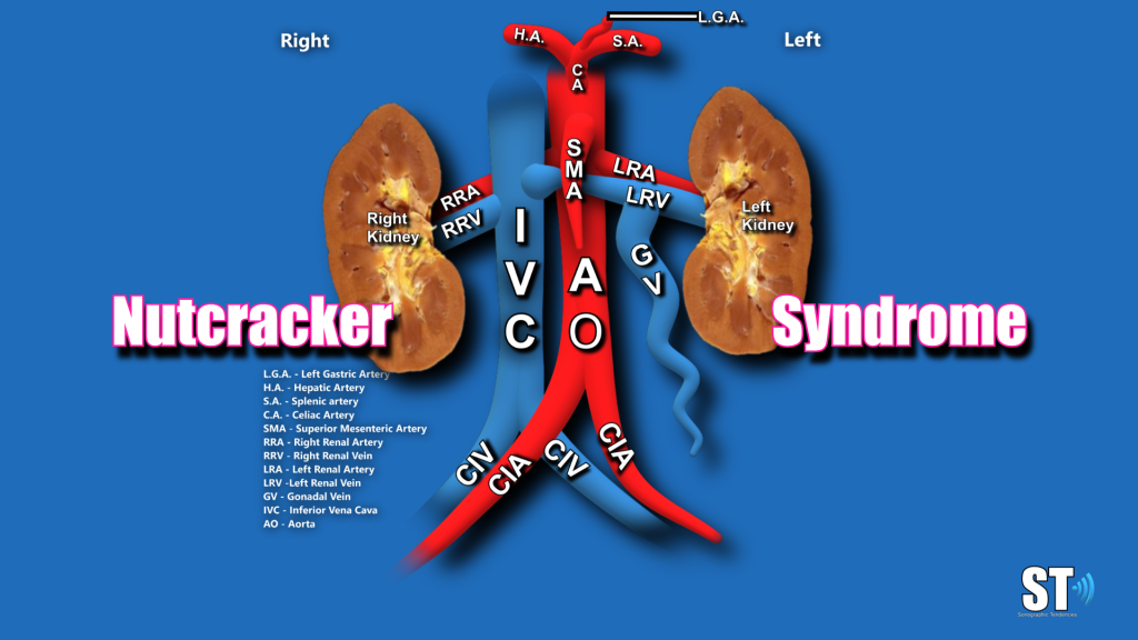 nutcracker syndrome causes